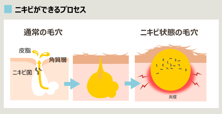 ニキビができるプロセス