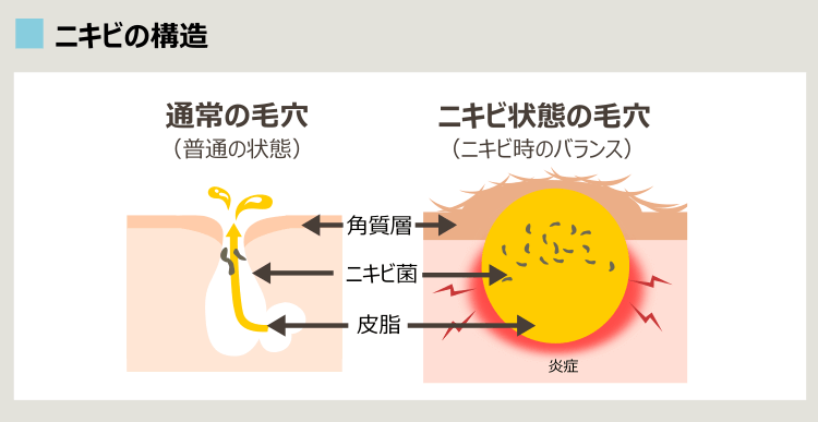 ニキビの構成要因