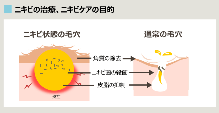 ニキビ治療、ニキビケア全般の考え