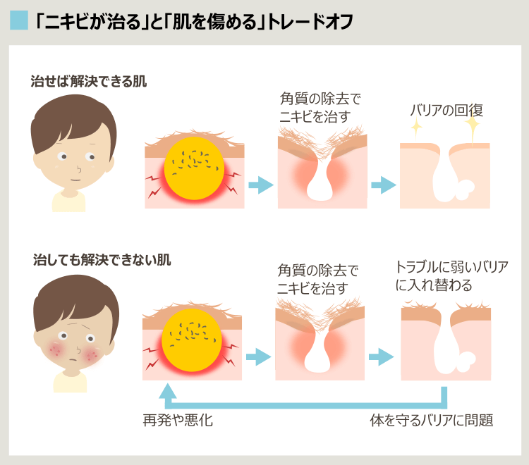 にきび治療でバリア損傷