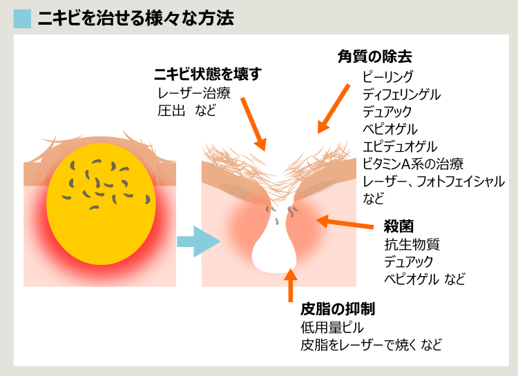 皮膚科での主なニキビ治療