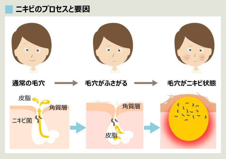 ニキビができるプロセス